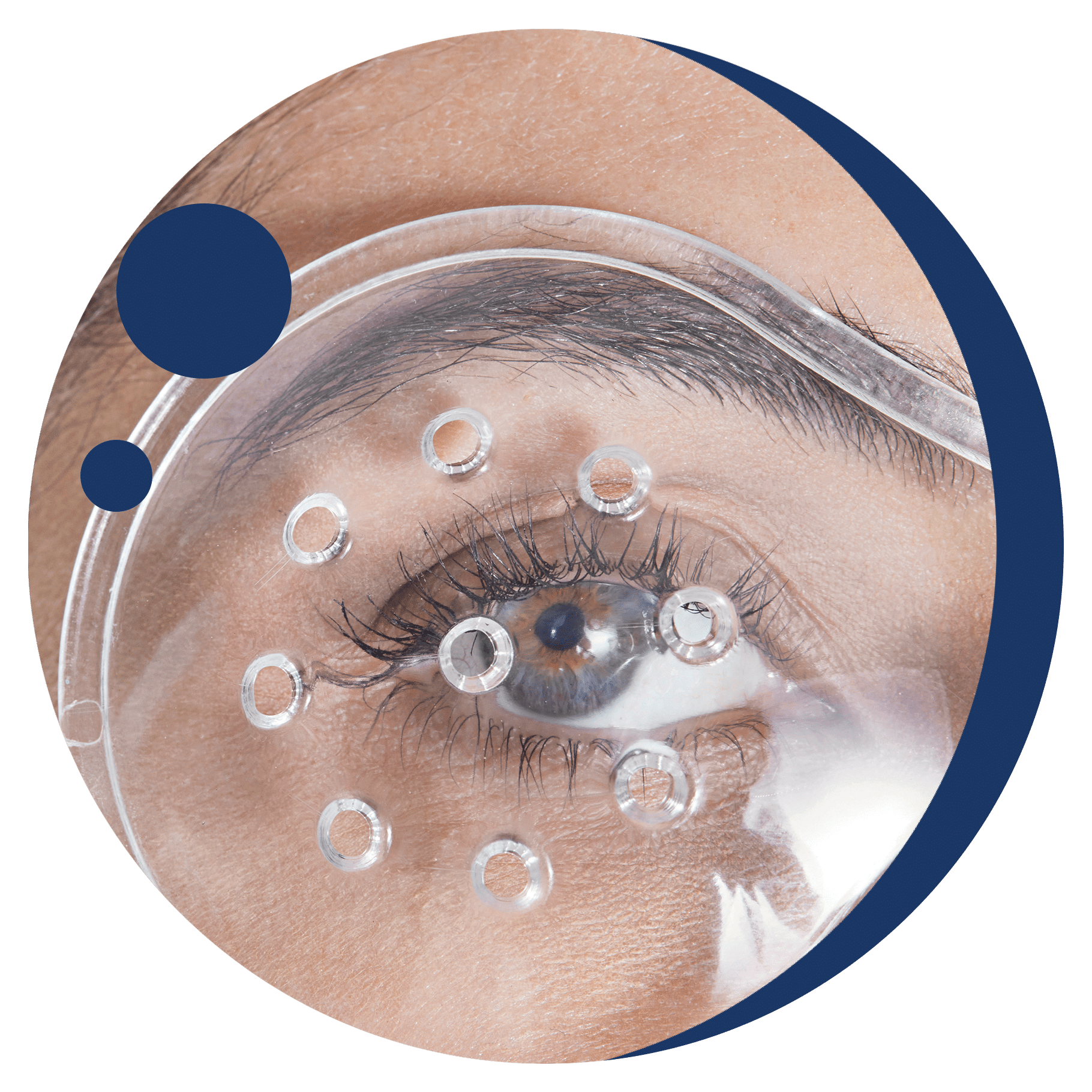 traumi oculari