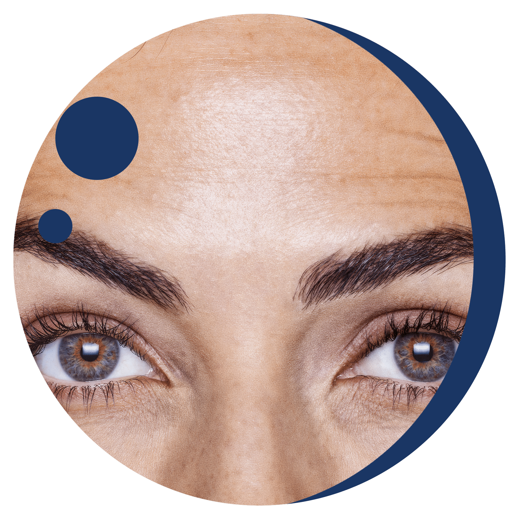 glaucoma